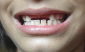 Responder entre os dentes